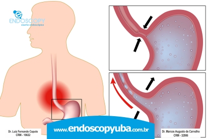 Refluxo gastroesofágico 